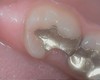 Porcelain crown case image 5