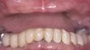Upper and lower arch rehabilitation before treatment