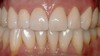 Upper arch after porcelain crown restoration
