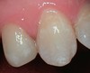 Porcelain crown case image 10
