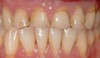 Upper arch before porcelain crown restoration