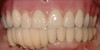 Upper and lower implant-supported restoration