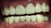 Porcelain crown case image 4