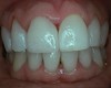 Porcelain crown case image 8