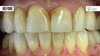 Empress restoration before treatment