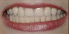 Upper and lower arch rehabilitation after treatment