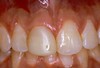 Front tooth before porcelain crown treatment