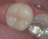 Porcelain crown case image 2