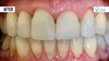 Empress restoration after treatment