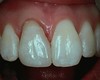 Porcelain crown case image 12
