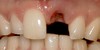 Missing upper central incisor before treatment