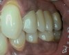 Porcelain fixed bridge after treatment