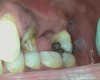 Porcelain fixed bridge before treatment