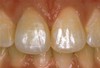 Front tooth after porcelain crown treatment