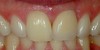 Upper central incisor restored with implant and porcelain crown