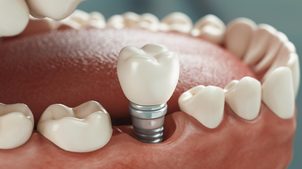 Dental Implants Soquel, CA
