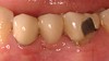 Porcelain bridge before treatment