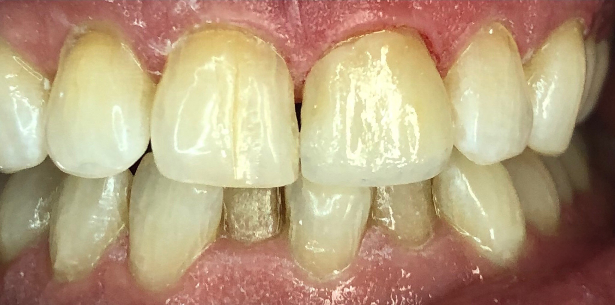 After: chipped front tooth repair with composite bonding, Soquel Dental Office in Soquel, CA