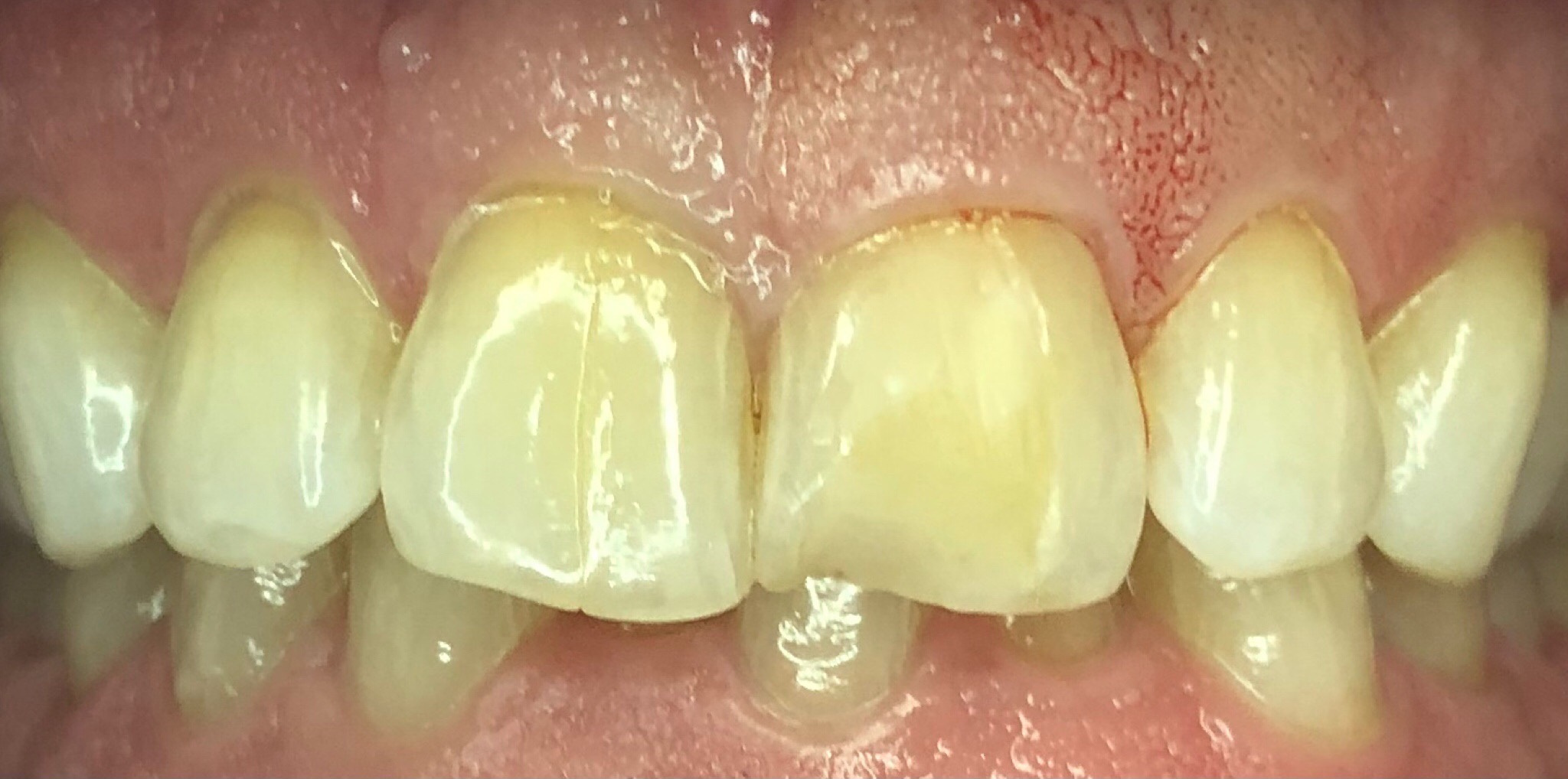 Before: chipped front tooth repair with composite bonding, Soquel Dental Office in Soquel, CA