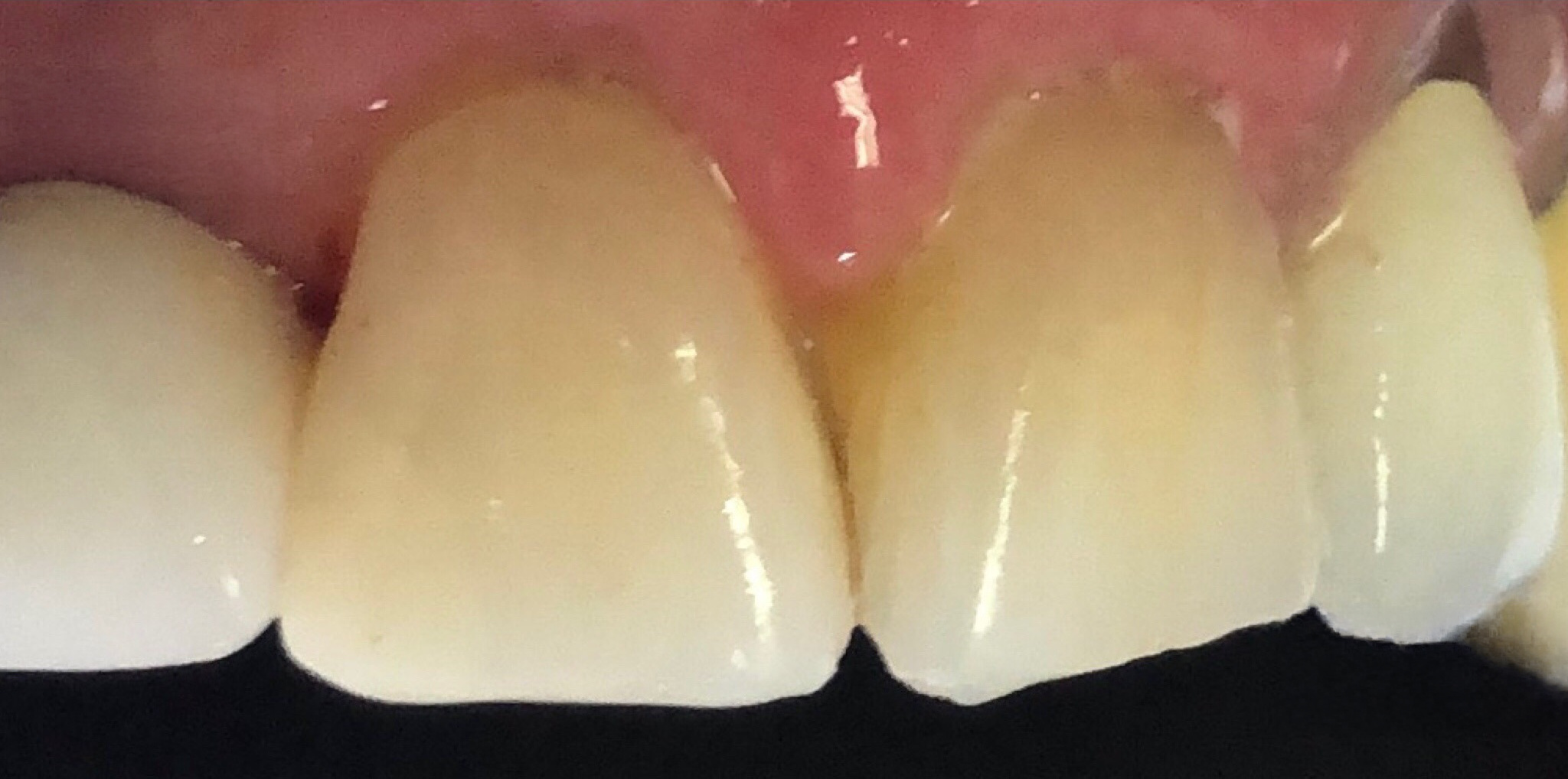 After: porcelain crowns shade-matched on upper front teeth, Soquel Dental Office in Soquel, CA