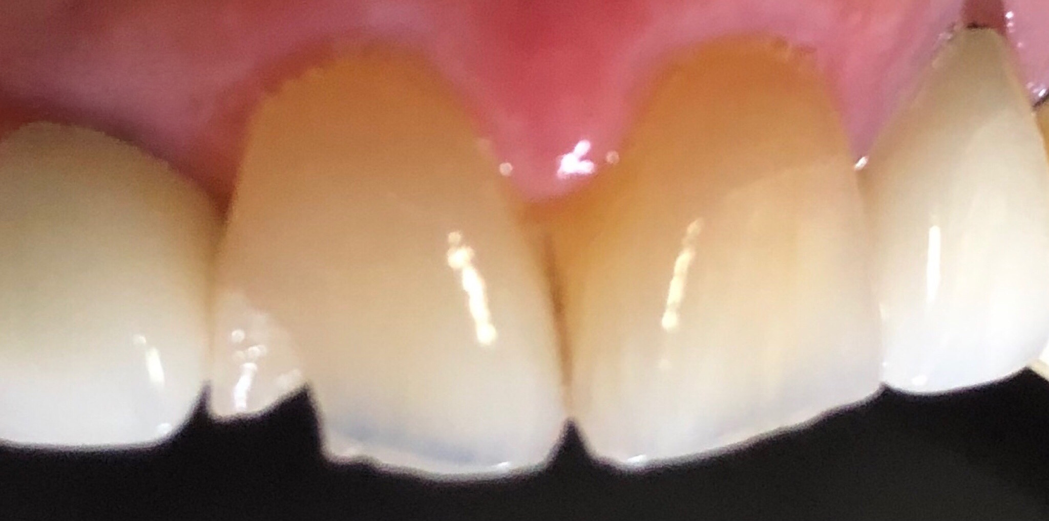 Before: porcelain crowns shade-matched on upper front teeth, Soquel Dental Office in Soquel, CA