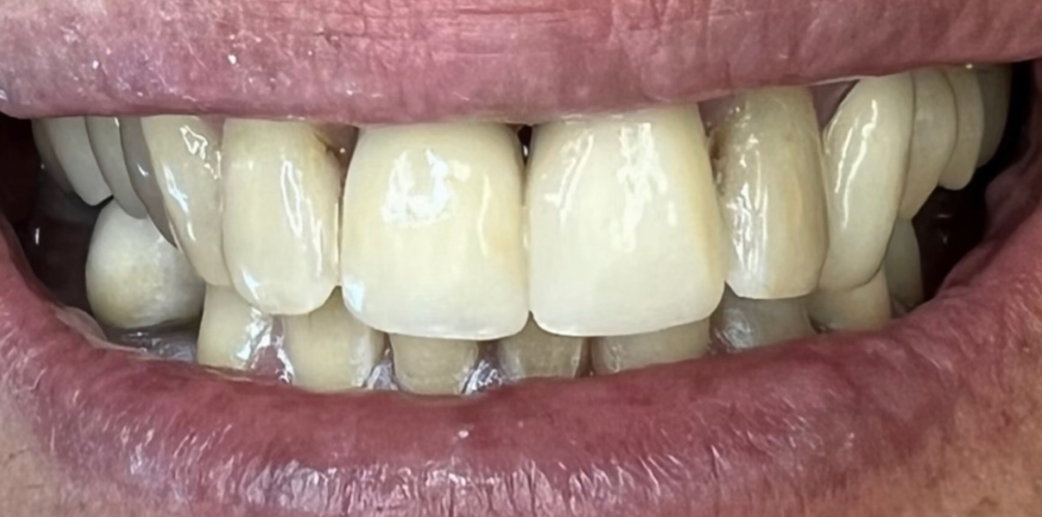 After: two custom shaded and stained EMAX crowns matched to the patient's natural teeth, Soquel Dental Office in Soquel, CA