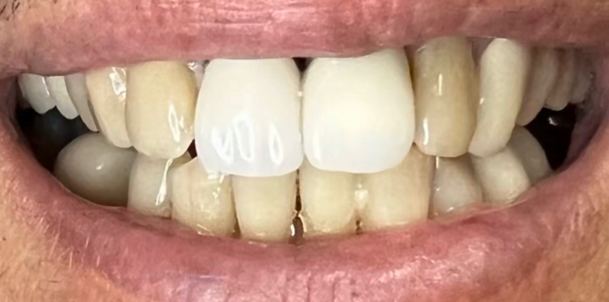Before: two custom shaded and stained EMAX crowns matched to the patient's natural teeth, Soquel Dental Office in Soquel, CA