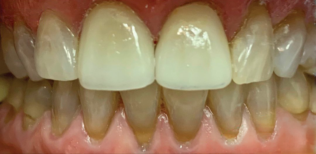 After: the two central incisors restored with EMAX crowns, matched to the surrounding teeth, Soquel Dental Office in Soquel, CA