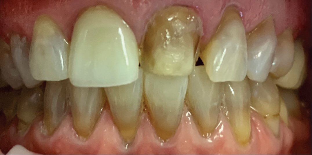Before: the two central incisors restored with EMAX crowns, matched to the surrounding teeth, Soquel Dental Office in Soquel, CA