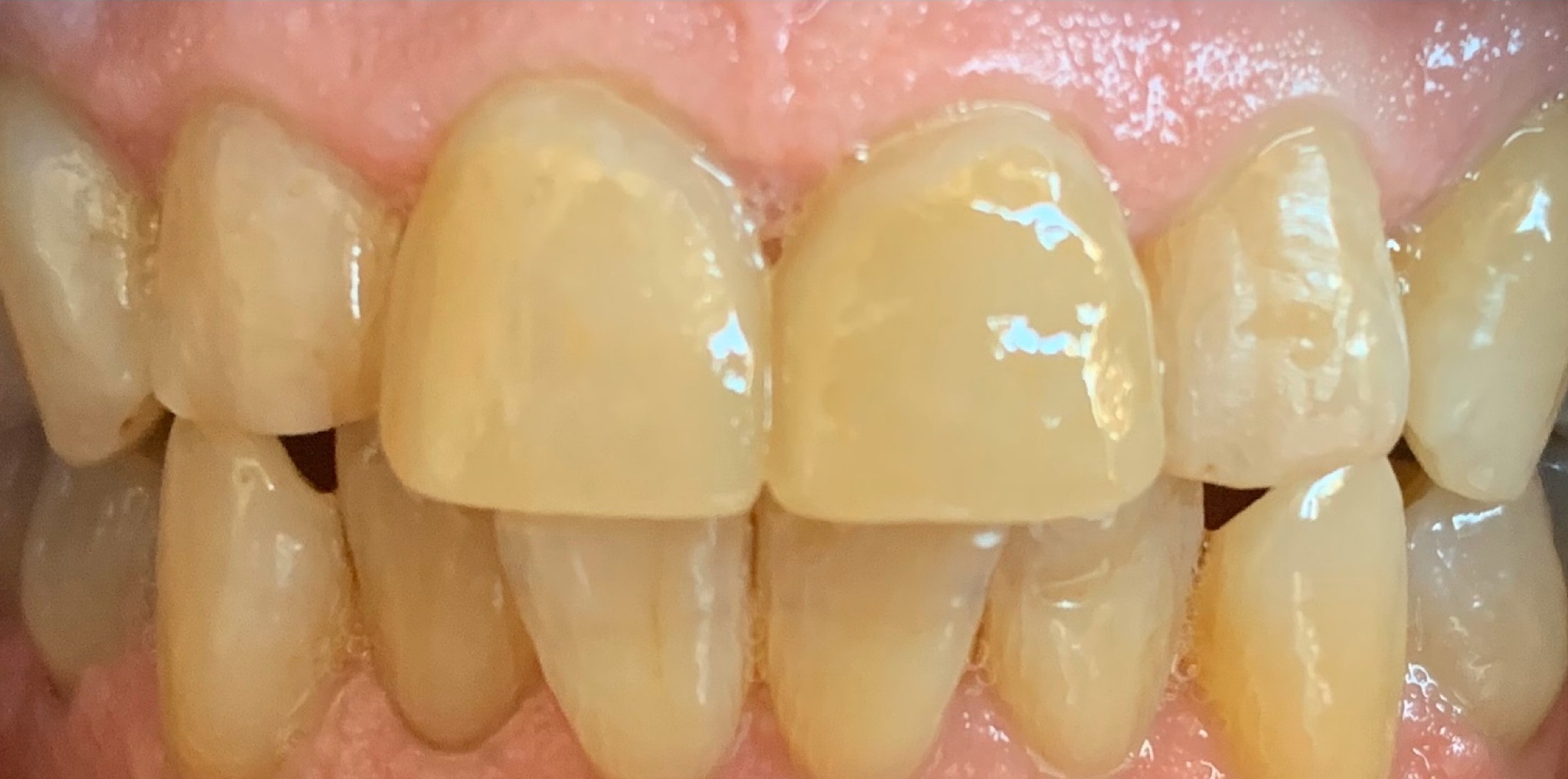 After: the two front teeth restored with EMAX crowns, color matched for a uniform new smile, Soquel Dental Office in Soquel, CA