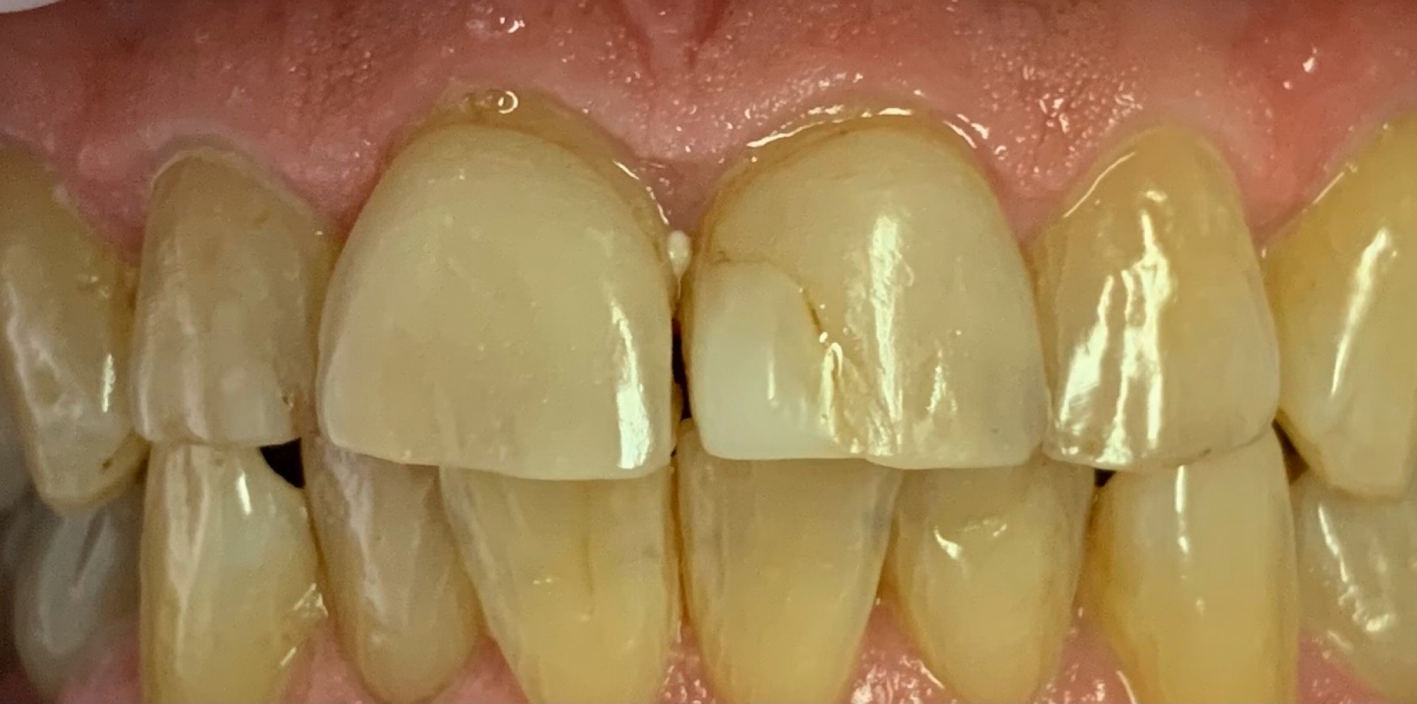 Before: the two front teeth restored with EMAX crowns, color matched for a uniform new smile, Soquel Dental Office in Soquel, CA