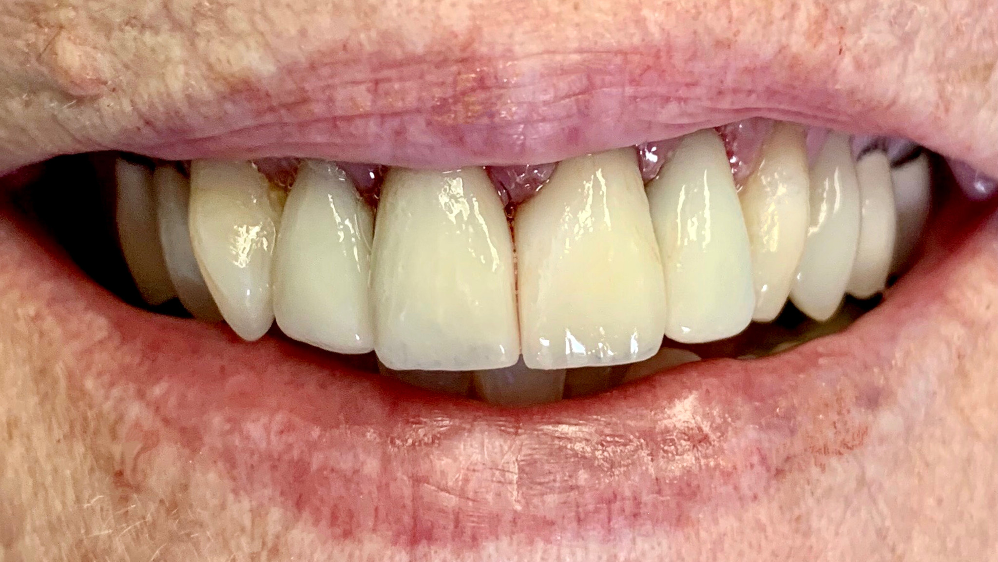 After: a smile restored with four EMAX crowns, matched to the patient's natural teeth, Soquel Dental Office in Soquel, CA