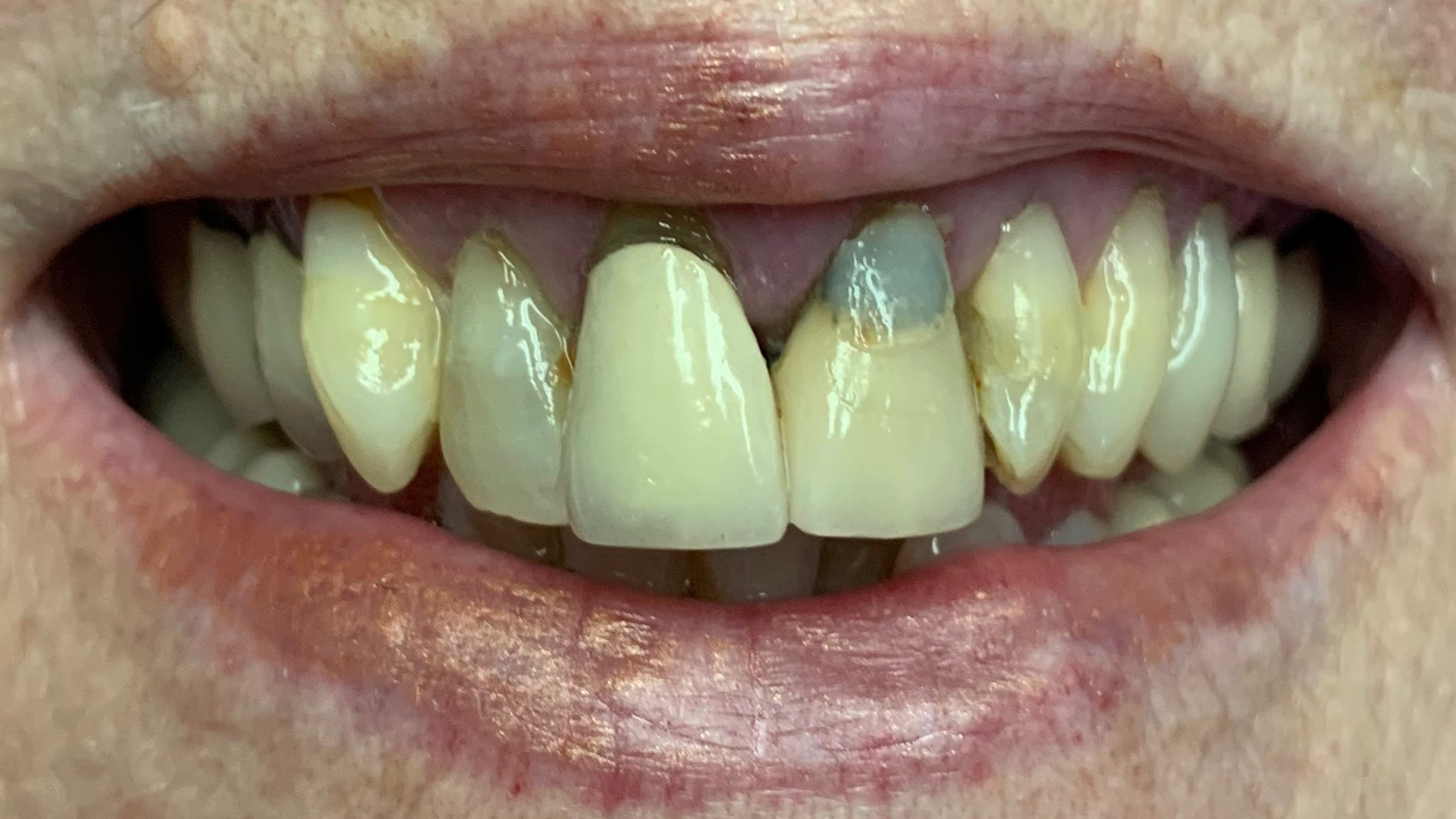 Before: a smile restored with four EMAX crowns, matched to the patient's natural teeth, Soquel Dental Office in Soquel, CA