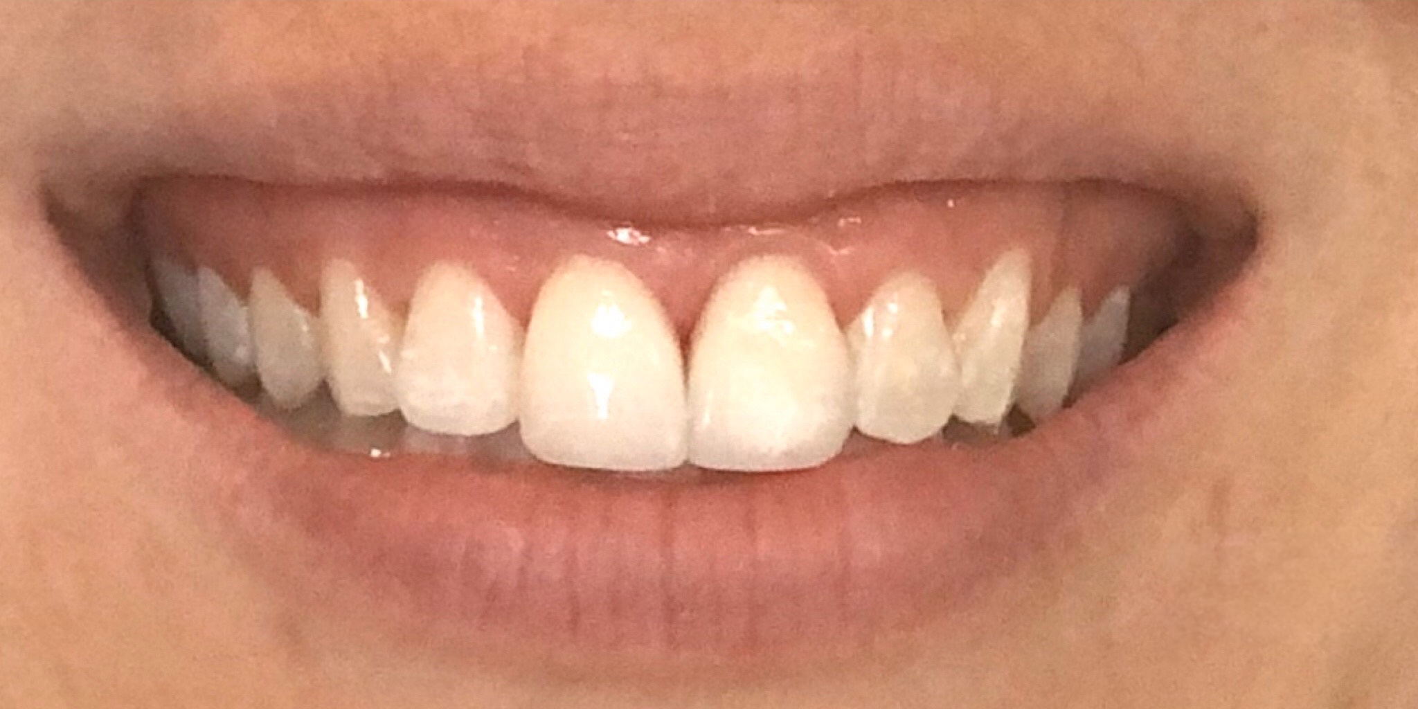 After: the patient's two front teeth replaced for the smile she always wanted, Soquel Dental Office in Soquel, CA