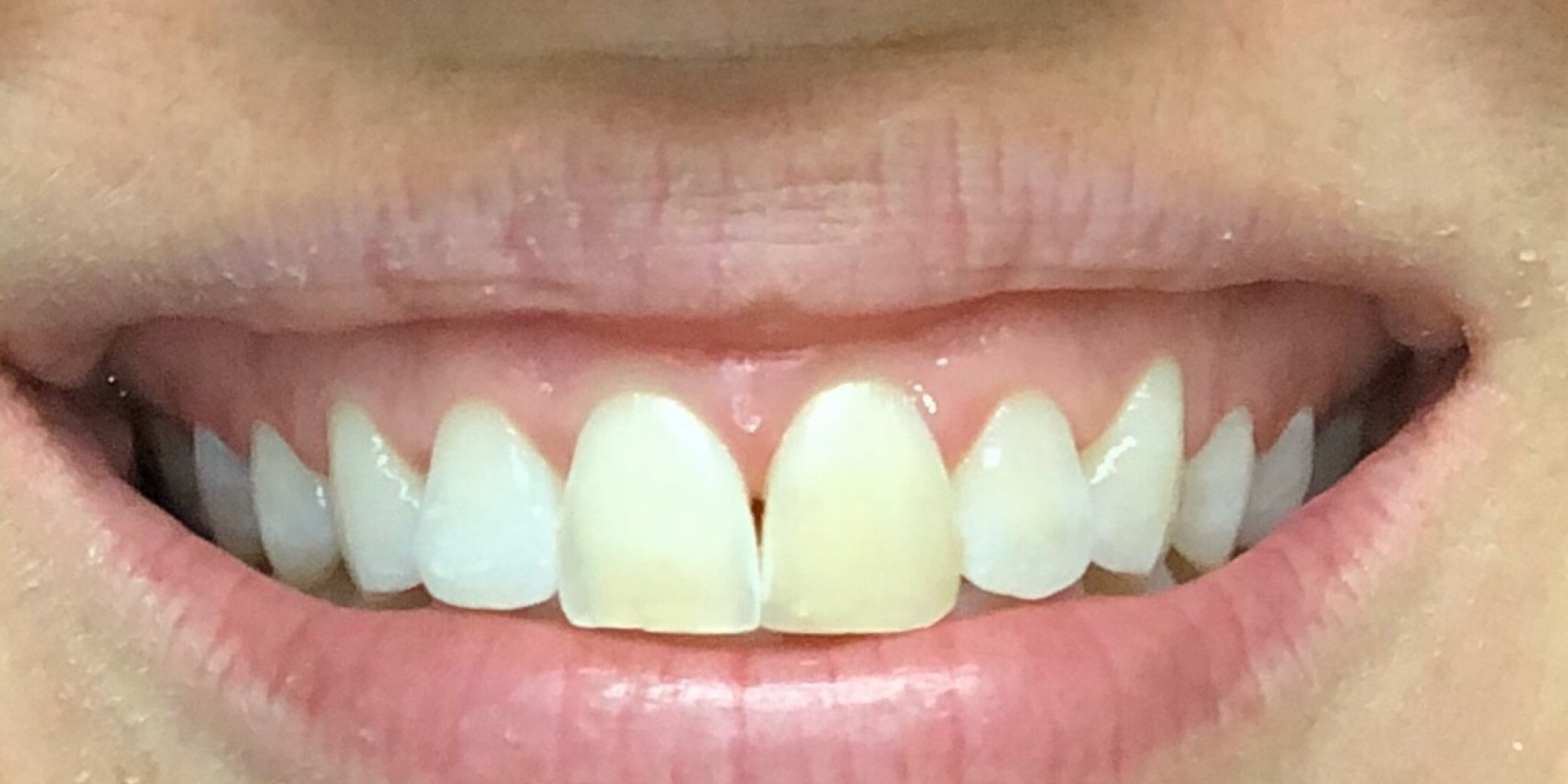 Before: the patient's two front teeth replaced for the smile she always wanted, Soquel Dental Office in Soquel, CA