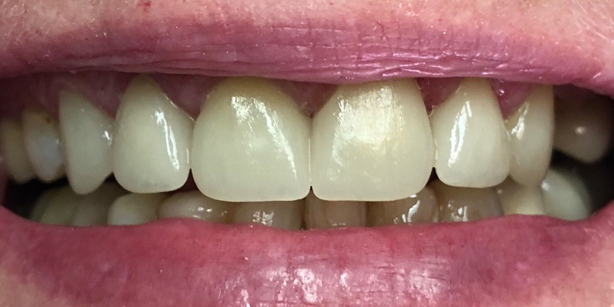 After: full mouth restoration, Soquel Dental Office in Soquel, CA