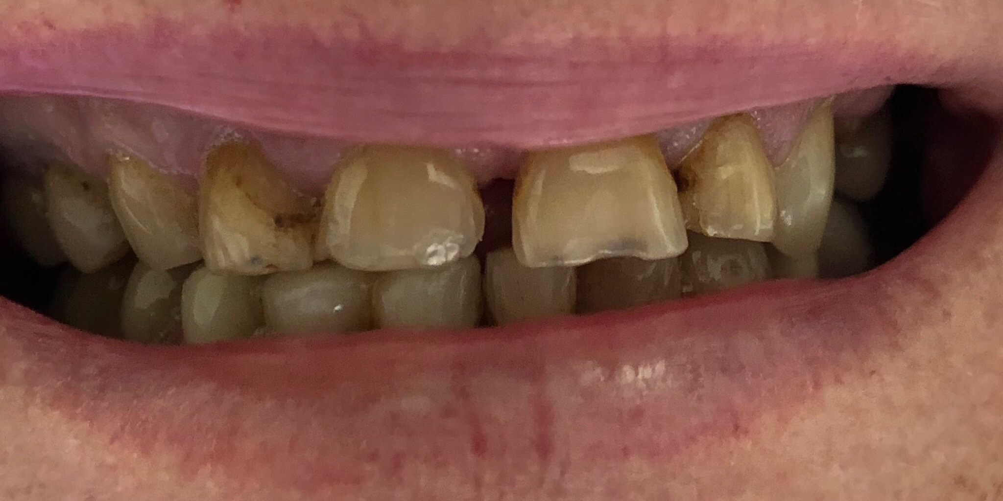 Before: full mouth restoration, Soquel Dental Office in Soquel, CA