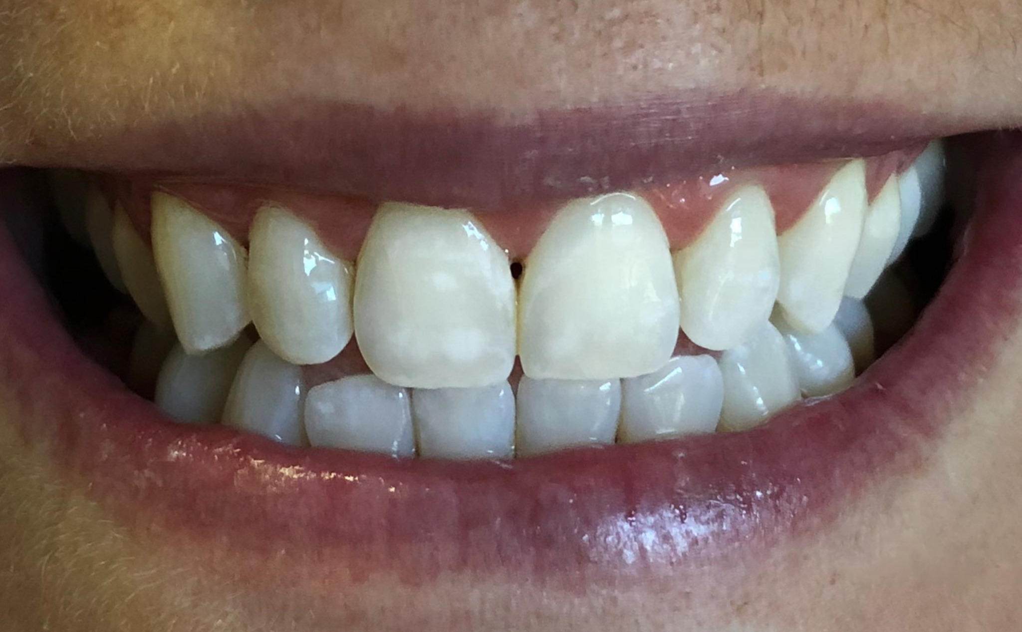 After: white spots on the front teeth removed with Icon no-drill resin treatment, Soquel Dental Office in Soquel, CA