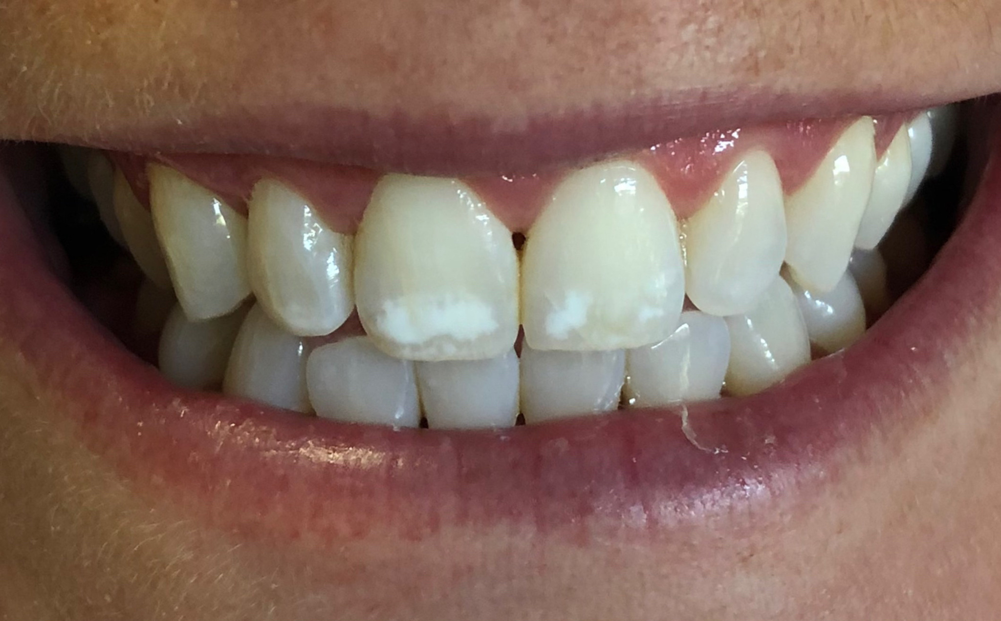 Before: white spots on the front teeth removed with Icon no-drill resin treatment, Soquel Dental Office in Soquel, CA