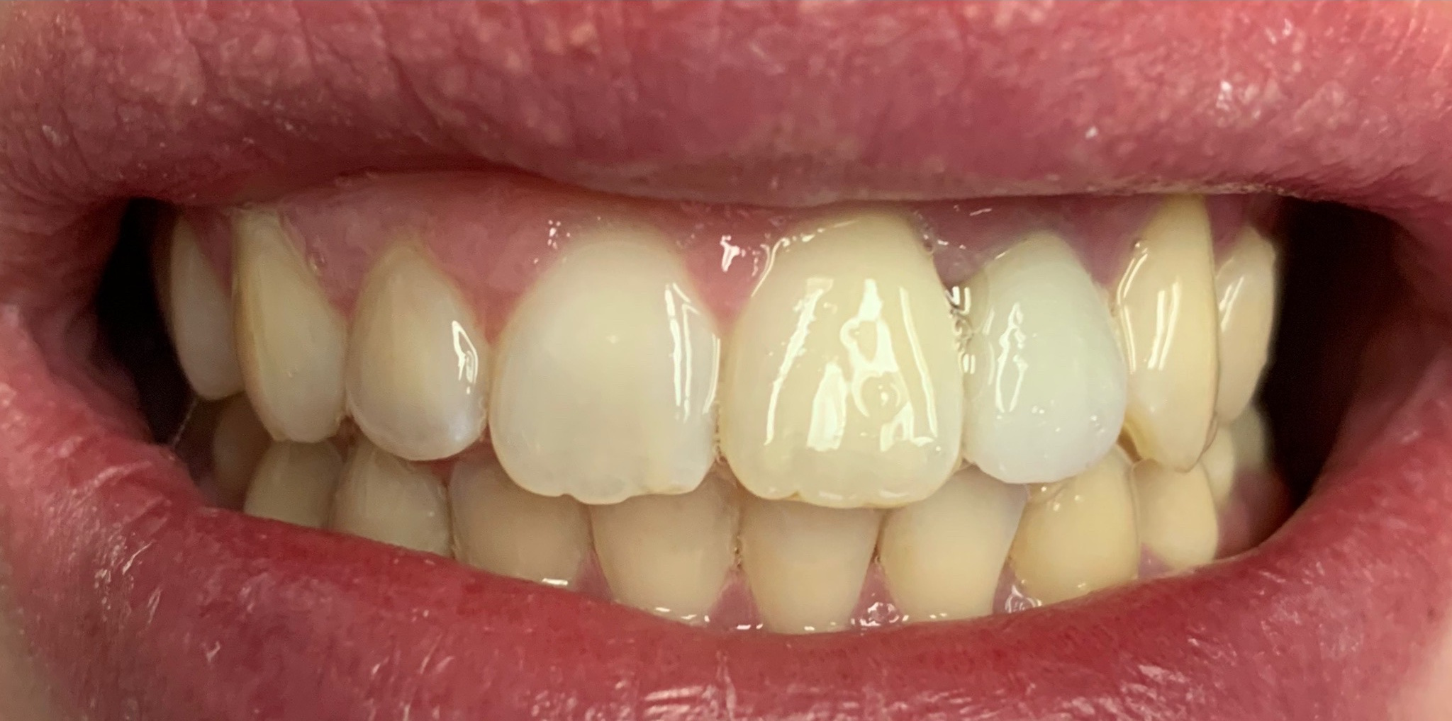 After: a dental implant, Soquel Dental Office in Soquel, CA