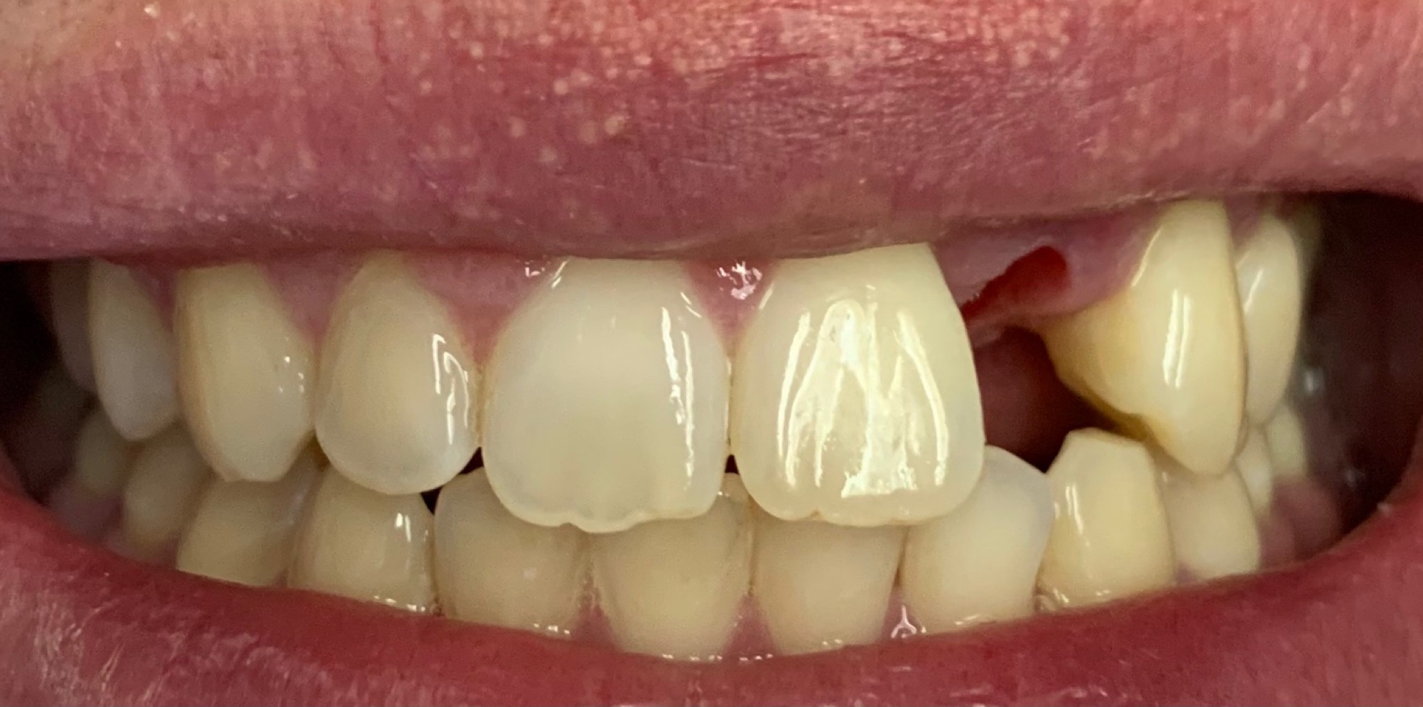 Before: a dental implant, Soquel Dental Office in Soquel, CA
