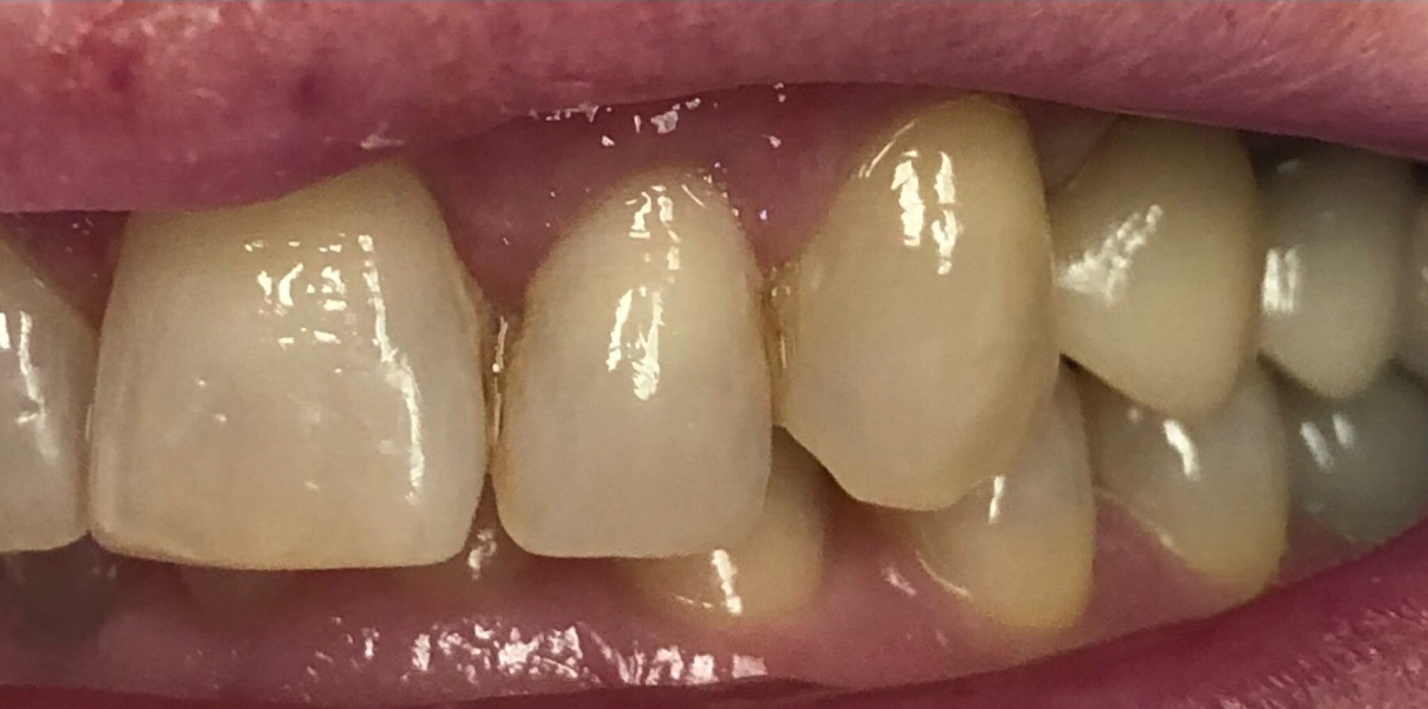 After: dental implant crown replacing a missing back tooth, Soquel Dental Office in Soquel, CA