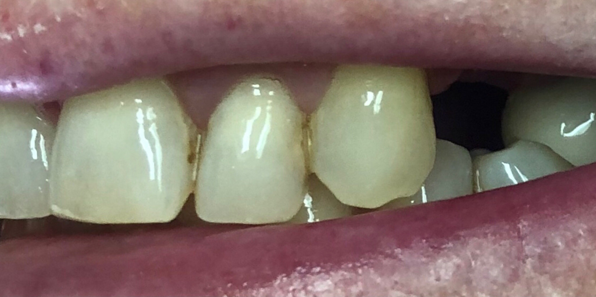 Before: dental implant crown replacing a missing back tooth, Soquel Dental Office in Soquel, CA