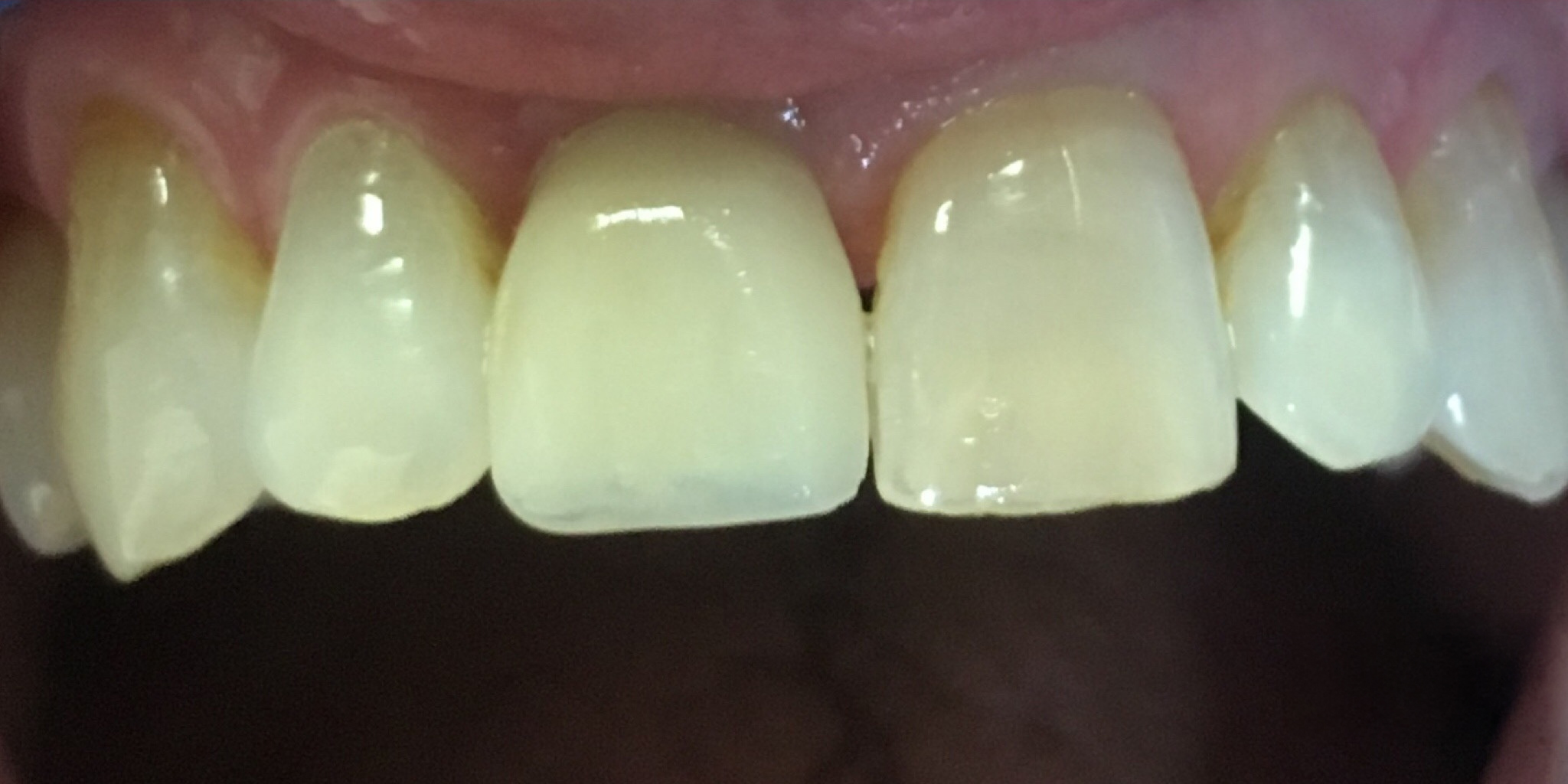 After: single tooth dental implant crown on an upper front tooth, Soquel Dental Office in Soquel, CA