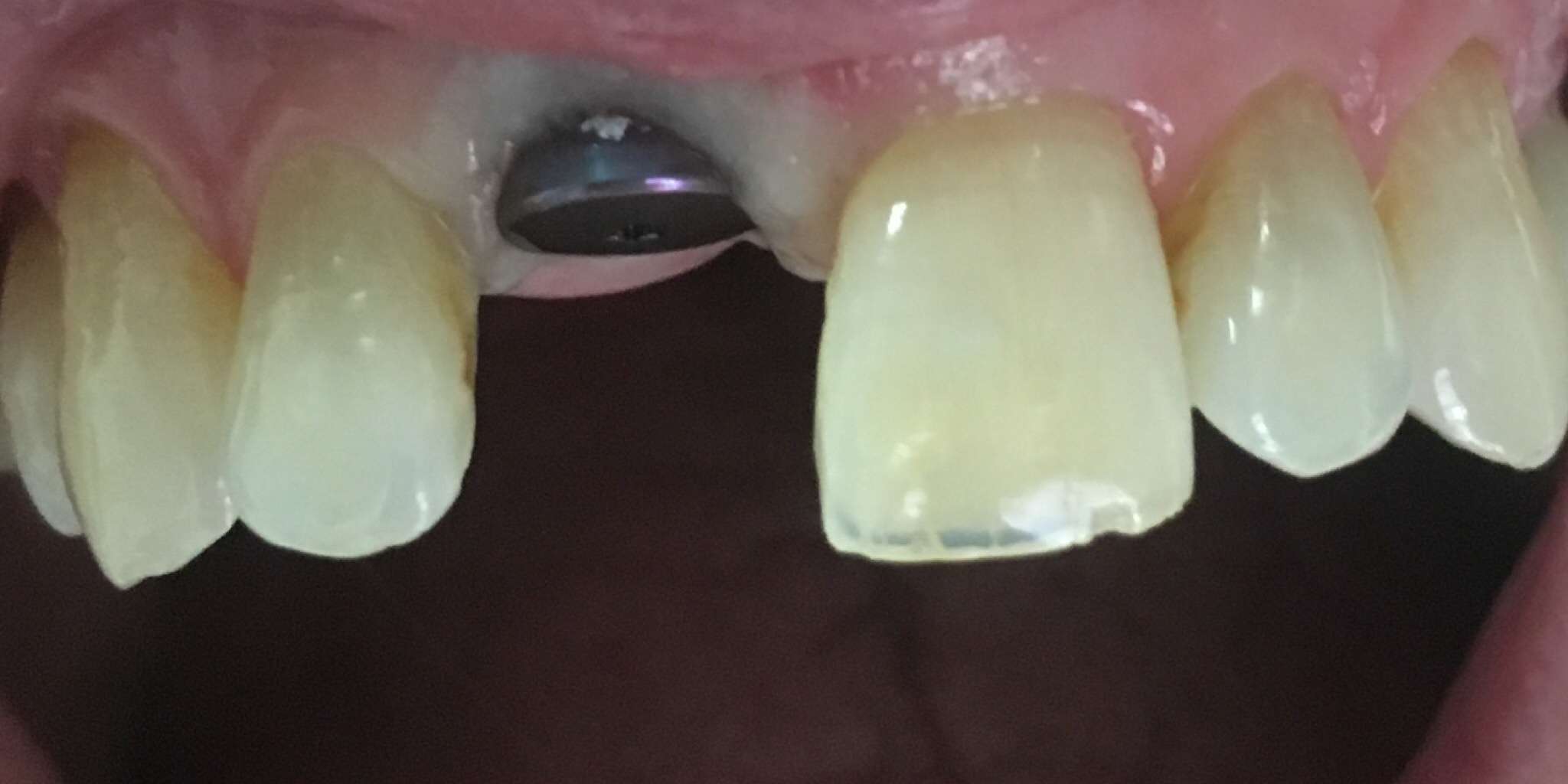Before: single tooth dental implant crown on an upper front tooth, Soquel Dental Office in Soquel, CA