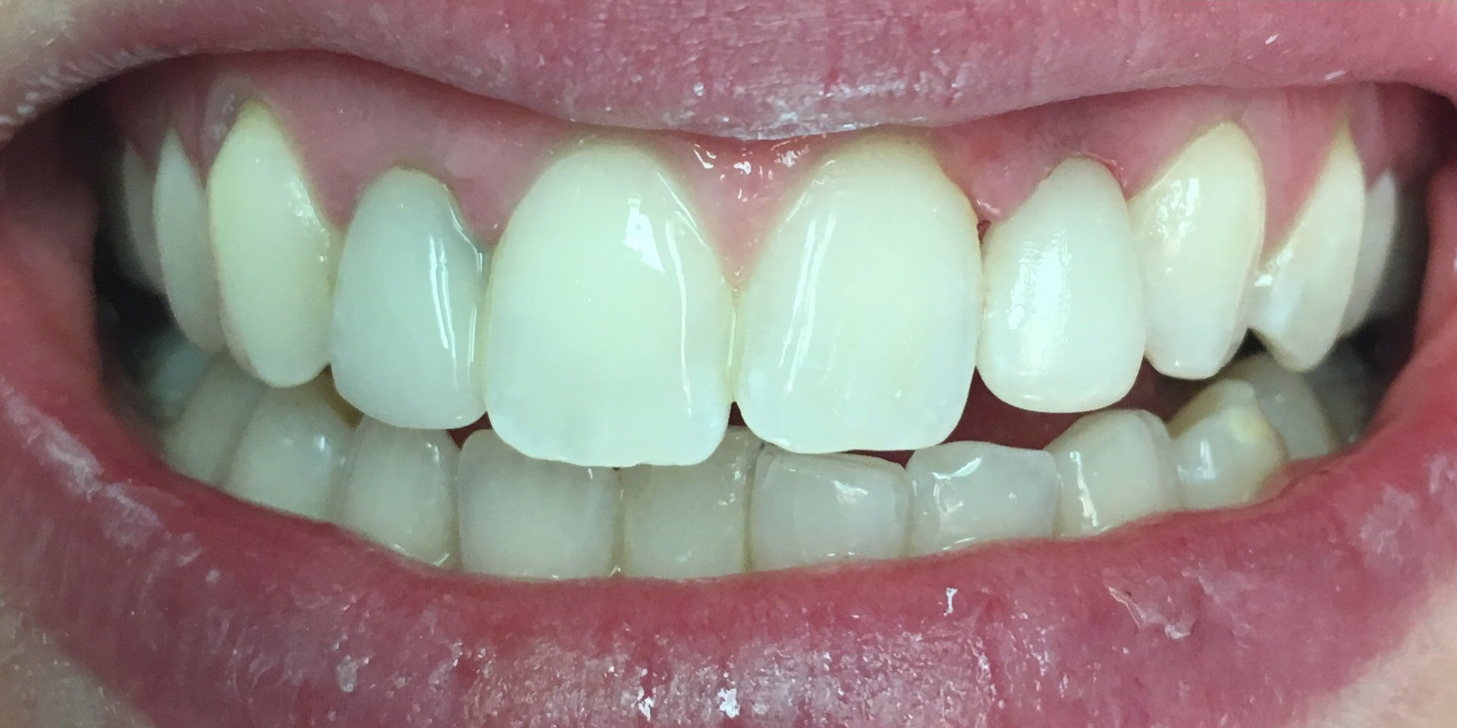After: single tooth dental implant crown on an upper lateral incisor, Soquel Dental Office in Soquel, CA