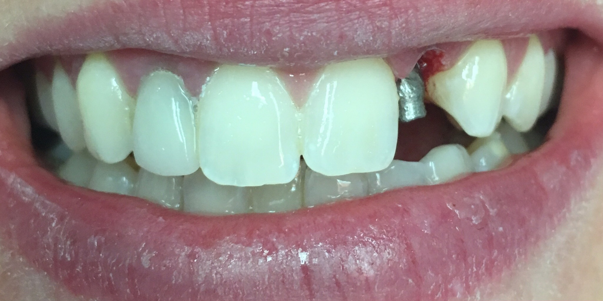 Before: single tooth dental implant crown on an upper lateral incisor, Soquel Dental Office in Soquel, CA