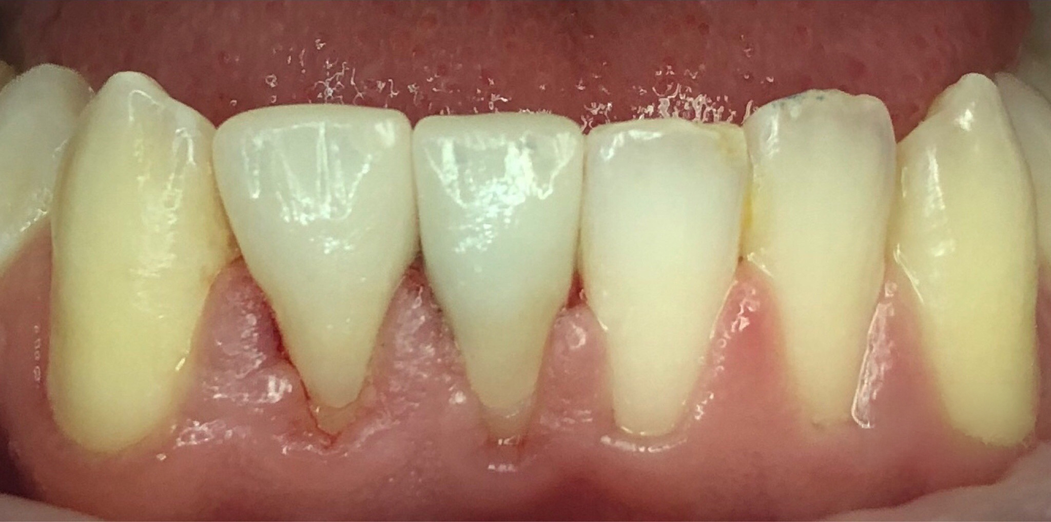 After: EMAX crowns on the lower front teeth, Soquel Dental Office in Soquel, CA