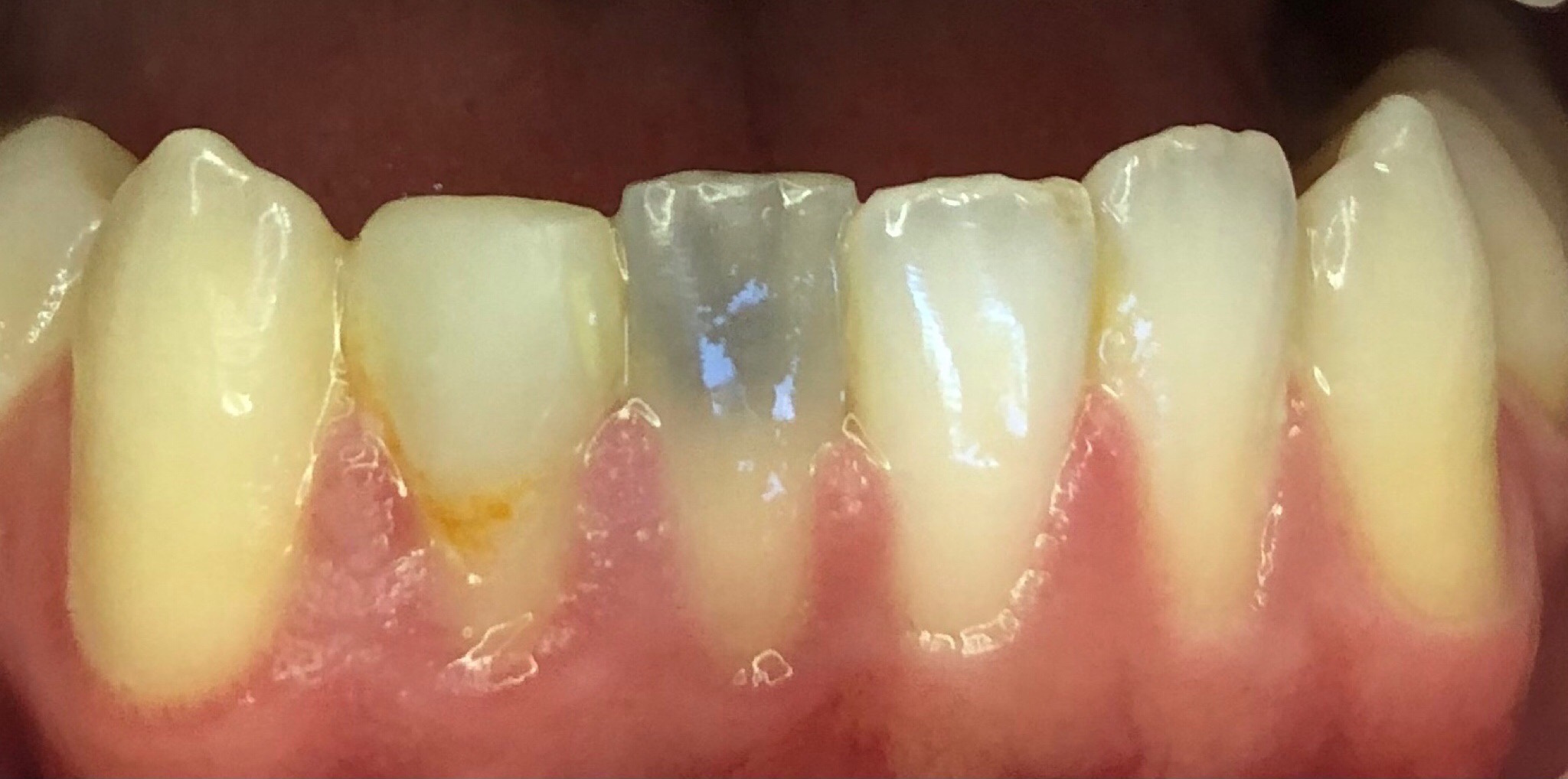 Before: EMAX crowns on the lower front teeth, Soquel Dental Office in Soquel, CA