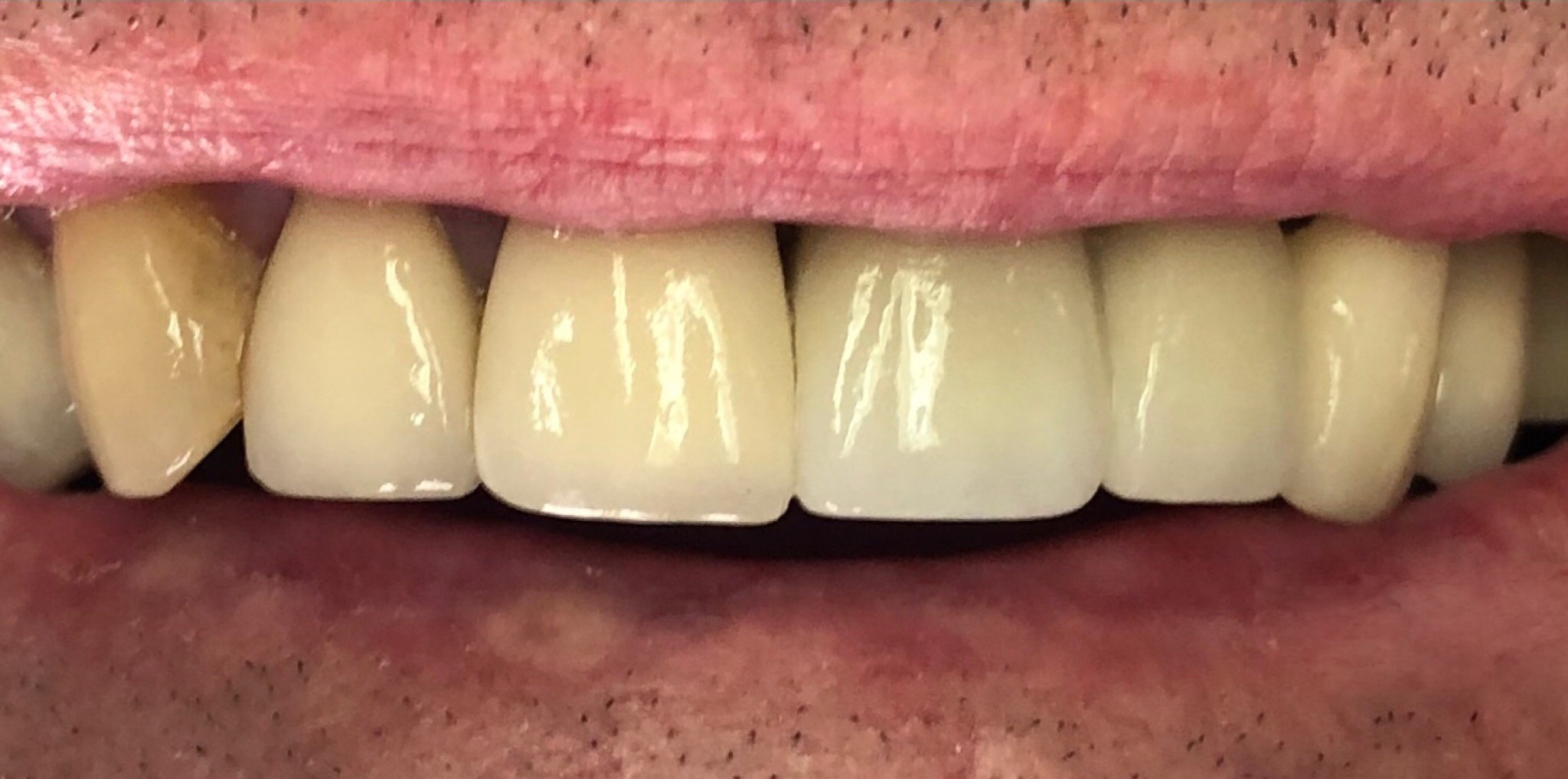 After: dental implants replacing four missing front teeth, Soquel Dental Office in Soquel, CA